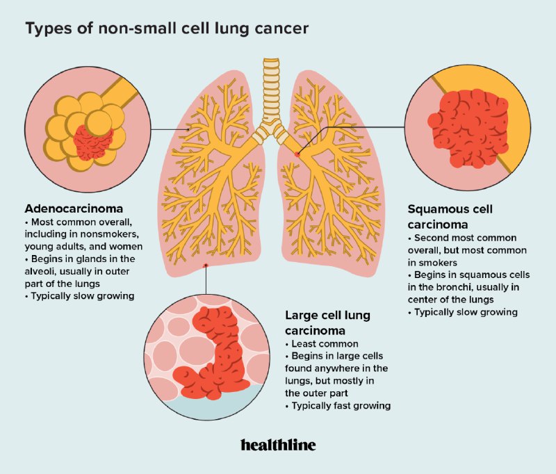 **راهکار متفاوت واکسن mRNA برای سرطان …