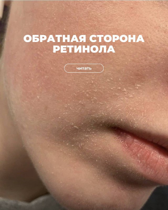 **Не верьте в магию ретинола**