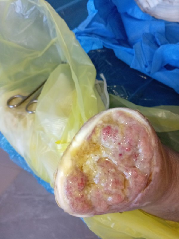 زخم ssi ناشی از آمپوتاسیون