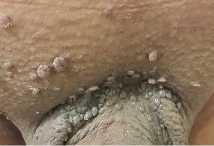 نمونه ای از زگیل تناسلی آلت …